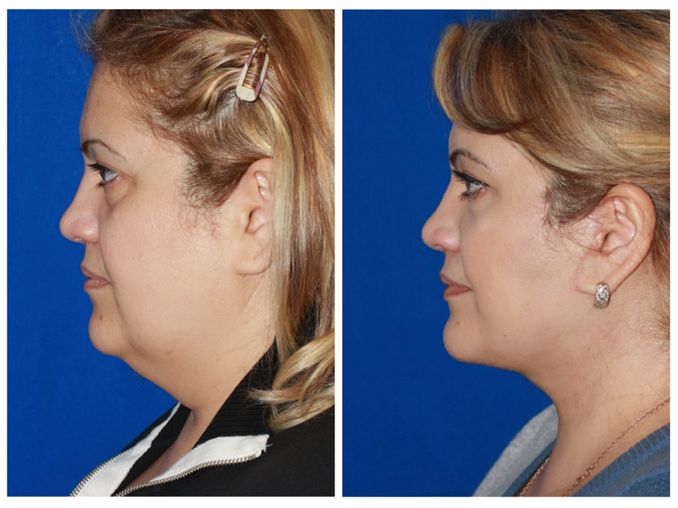 Liposuction / Liposculpture – Constantine Cosmetic Surgery